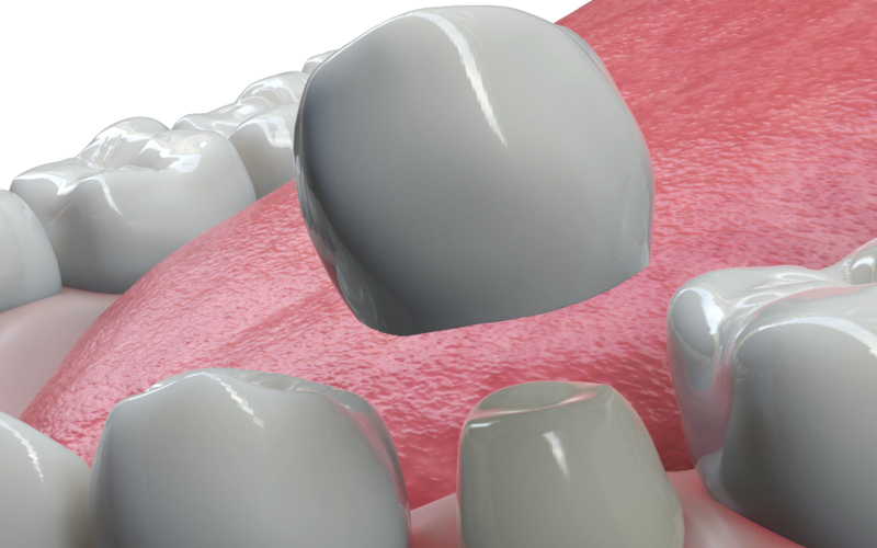 Dental Crowns: What They Are and Why We Need Them